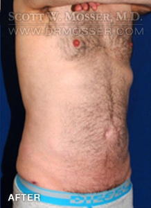 Liposuction - Abdomen & Flanks Patient 23232 After Photo # 4