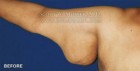 Arm Lift Patient 15116 Before Photo Thumbnail # 1