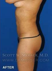 Liposuction - Abdomen & Flanks Patient 33709 After Photo # 10