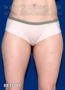 Liposuction - Thighs Patient 82329 Before Photo Thumbnail # 1
