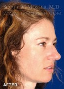 Upper Blepharoplasty Patient 26830 After Photo Thumbnail # 4
