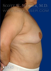 Breast Reduction Patient 54296 After Photo # 6