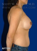 Breast Augmentation Patient 47902 After Photo Thumbnail # 6