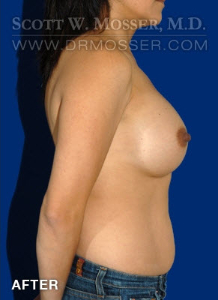 Breast Augmentation Patient 47902 After Photo # 6