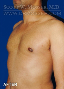 Liposuction - Chest Patient 51091 After Photo # 6