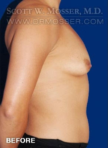 Breast Augmentation Patient 13760 Before Photo # 5