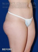 Liposuction - Thighs Patient 42034 Before Photo Thumbnail # 3