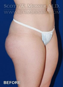 Liposuction - Thighs Patient 42034 Before Photo # 3