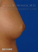 Nipple Inversion Correction Patient 38571 Before Photo Thumbnail # 3