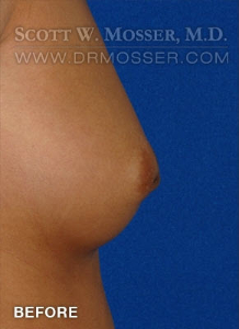 Nipple Inversion Correction Patient 38571 Before Photo # 3