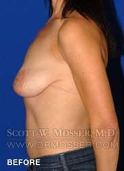 Breast Lift With Implants Patient 19074 Before Photo # 9