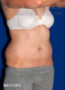Liposuction - Abdomen & Flanks Patient 75438 Before Photo Thumbnail # 5