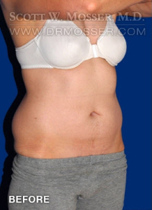Liposuction - Abdomen & Flanks Patient 75438 Before Photo # 5