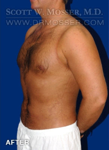 Liposuction - Chest Patient 51212 After Photo # 4