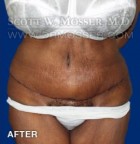 Abdominoplasty Patient 30014 After Photo Thumbnail # 2