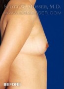 Breast Augmentation Patient 66017 Before Photo Thumbnail # 5