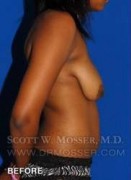 Breast Lift Without Implants Patient 55667 Before Photo Thumbnail # 7