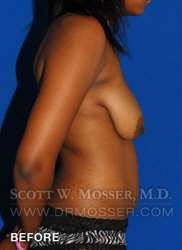 Breast Lift Without Implants Patient 55667 Before Photo # 7