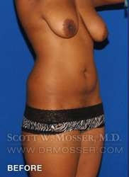 Liposuction - Abdomen & Flanks Patient 11942 Before Photo # 3