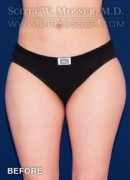 Liposuction - Thighs Patient 40477 Before Photo Thumbnail # 1