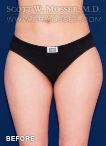 Liposuction - Thighs Patient 40477 Before Photo # 1