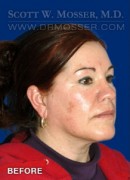 Upper Blepharoplasty Patient 92612 Before Photo Thumbnail # 3