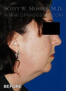 Chin Implant Patient 26401 Before Photo # 1