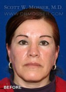 Upper Blepharoplasty Patient 92612 Before Photo Thumbnail # 1
