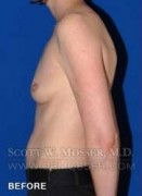 Breast Asymmetry Correction Patient 37996 Before Photo Thumbnail # 3
