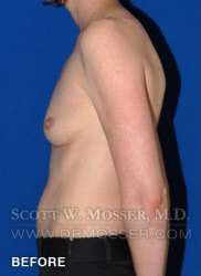 Breast Asymmetry Correction Patient 37996 Before Photo # 3