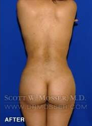 Liposuction - Abdomen & Flanks Patient 33709 After Photo # 12