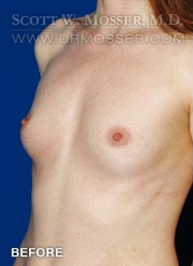 Breast Augmentation Patient 88566 Before Photo # 5