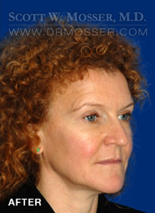 Upper Blepharoplasty Patient 45312 After Photo # 4