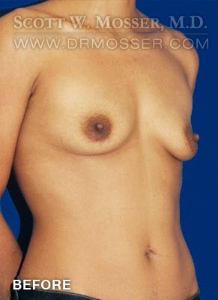 Breast Augmentation Patient 83067 Before Photo # 3