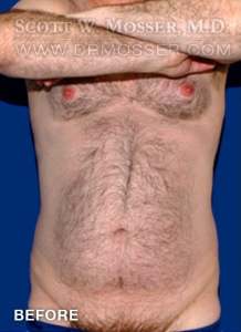Liposuction - Abdomen & Flanks Patient 23232 Before Photo # 1