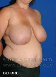 Breast Reduction Patient 24410 Before Photo # 3