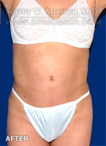 Liposuction - Abdomen & Flanks Patient 68884 After Photo # 2
