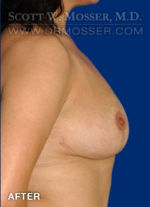 Breast Reduction Patient 13262 After Photo # 6