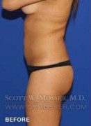 Liposuction - Abdomen & Flanks Patient 33709 Before Photo Thumbnail # 9
