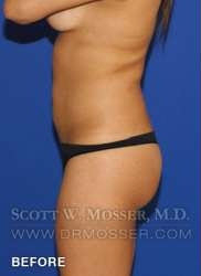 Liposuction - Abdomen & Flanks Patient 33709 Before Photo # 9