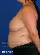 Breast Reduction Patient 24410 Before Photo Thumbnail # 9