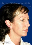 Upper Blepharoplasty Patient 81608 Before Photo Thumbnail # 3