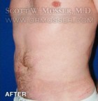 Liposuction - Abdomen & Flanks Patient 62116 After Photo Thumbnail # 2