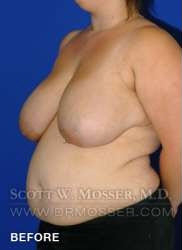 Breast Reduction Patient 24410 Before Photo # 5