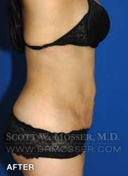 Liposuction - Abdomen & Flanks Patient 30590 After Photo # 8