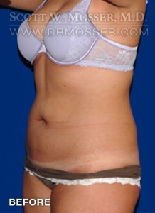 Liposuction - Abdomen & Flanks Patient 79590 Before Photo # 3