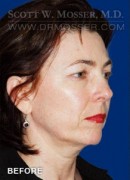 Chin Implant Patient 16572 Before Photo Thumbnail # 7