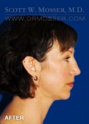 Upper Blepharoplasty Patient 81608 After Photo Thumbnail # 6