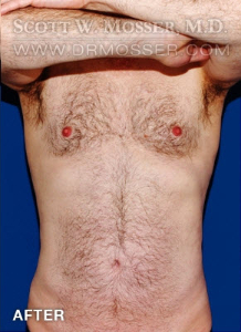 Liposuction - Abdomen & Flanks Patient 23232 After Photo # 2