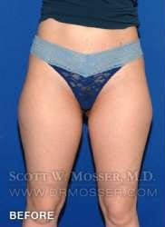 Liposuction - Thighs Patient 68368 Before Photo # 1